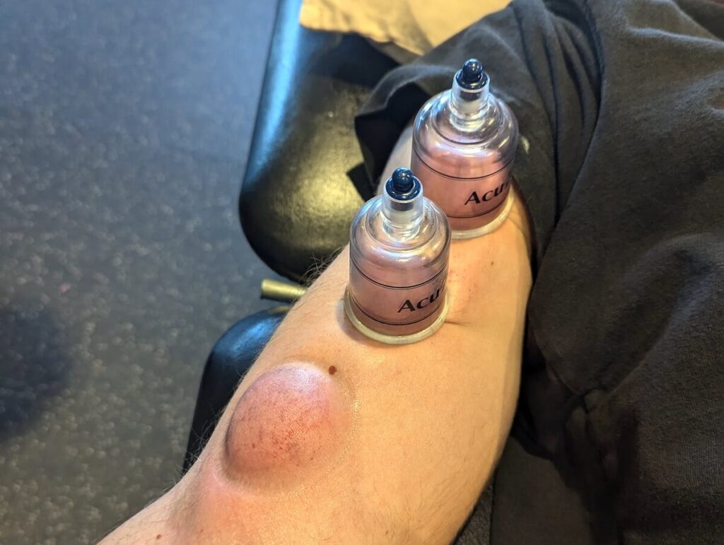 Cupping, Physical Therapy, Holland, MI